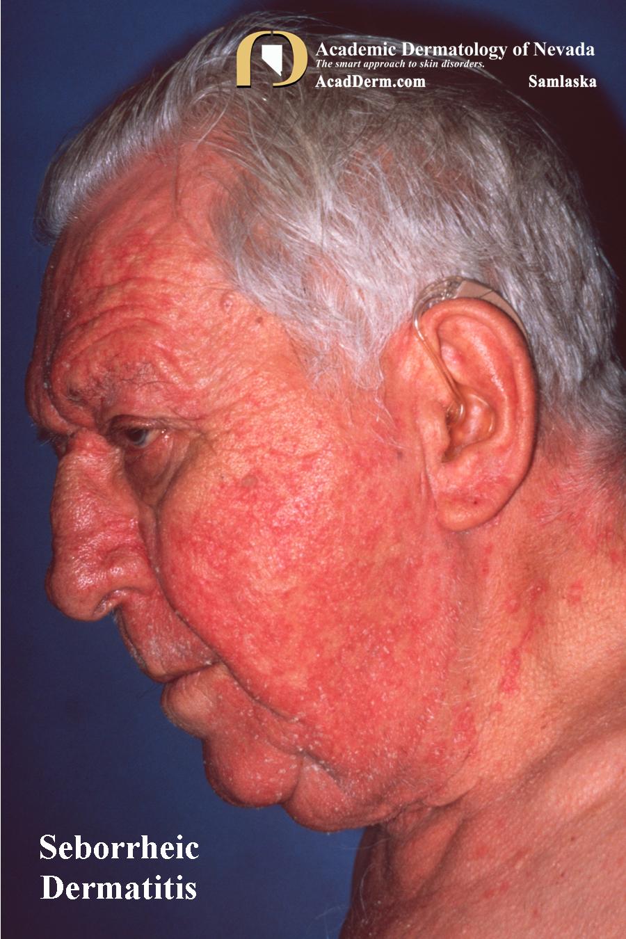 Seborrheic Dermatitis: Dandruff, Cradle Cap...