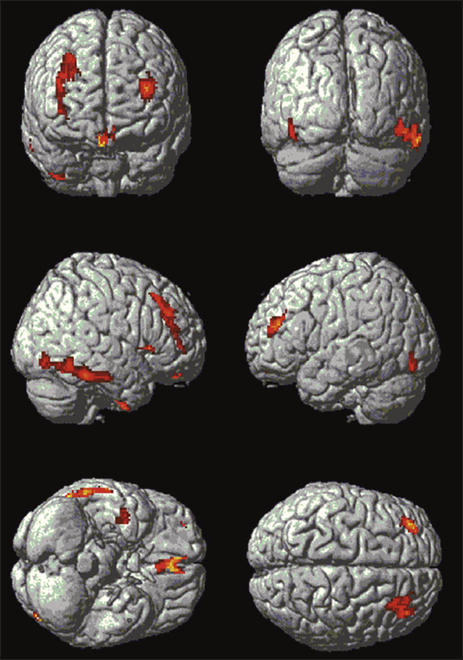 Serotonin 2A Receptors and Visual Hallucinations in Parkinson Disease ...