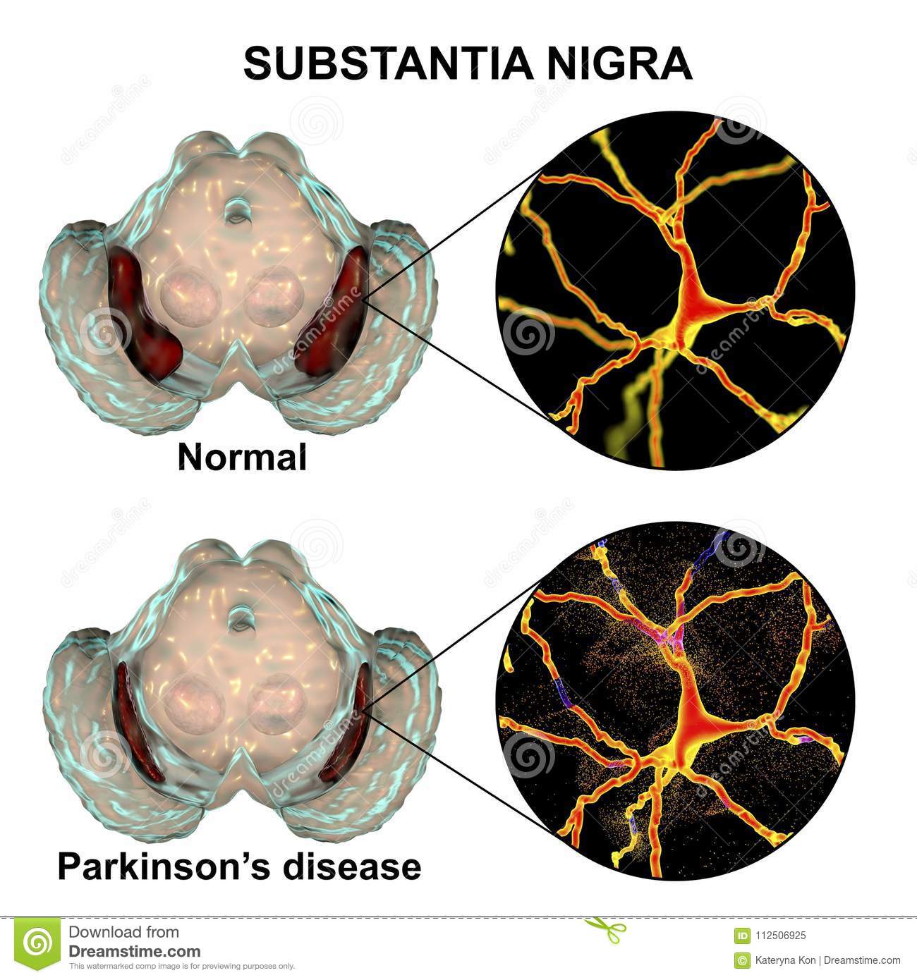 Substantia Nigra In Norm And In Parkinson`s Disease Stock Image