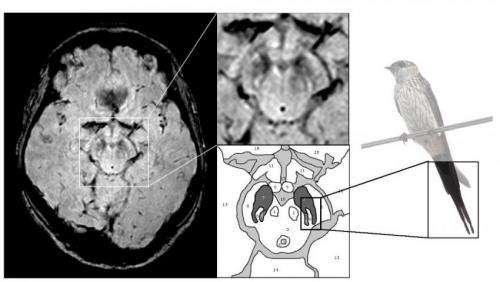 tell tail mri image diagnosis for parkinsons disease