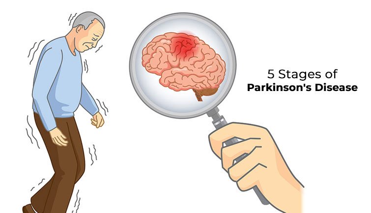 The 5 Stages of Parkinsons Disease : Vimhans Nayati Hospital