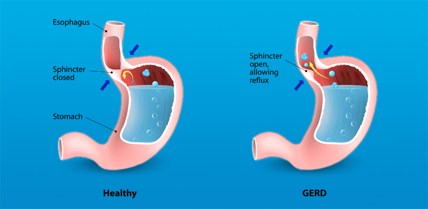 Treatment of Gastro Esophageal Reflux Disease (GERD) with ...