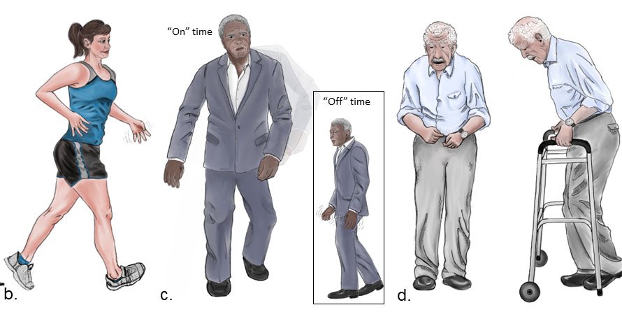 UF neurologists create a new image of Parkinson disease ...