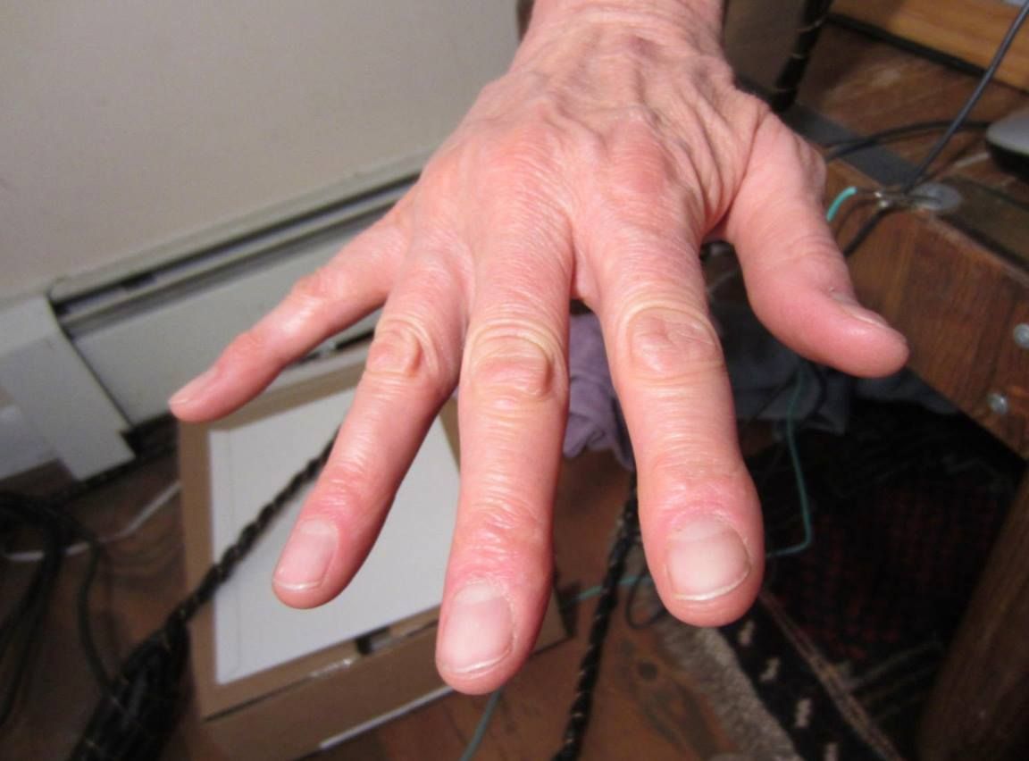 Understanding & Naturally Treating Shaky Hands