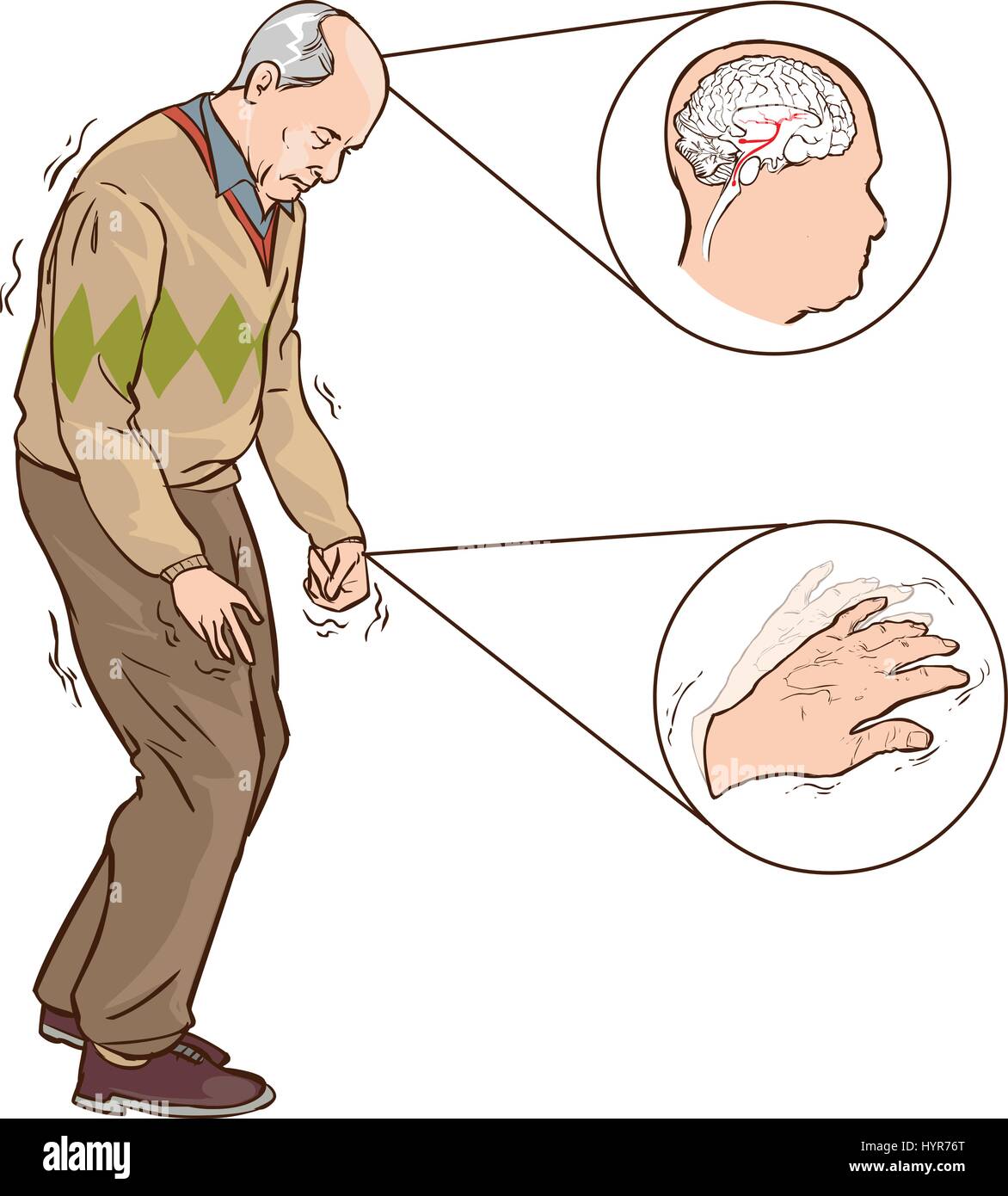 vector illustration of aOld man with Parkinson symptoms difficult Stock ...
