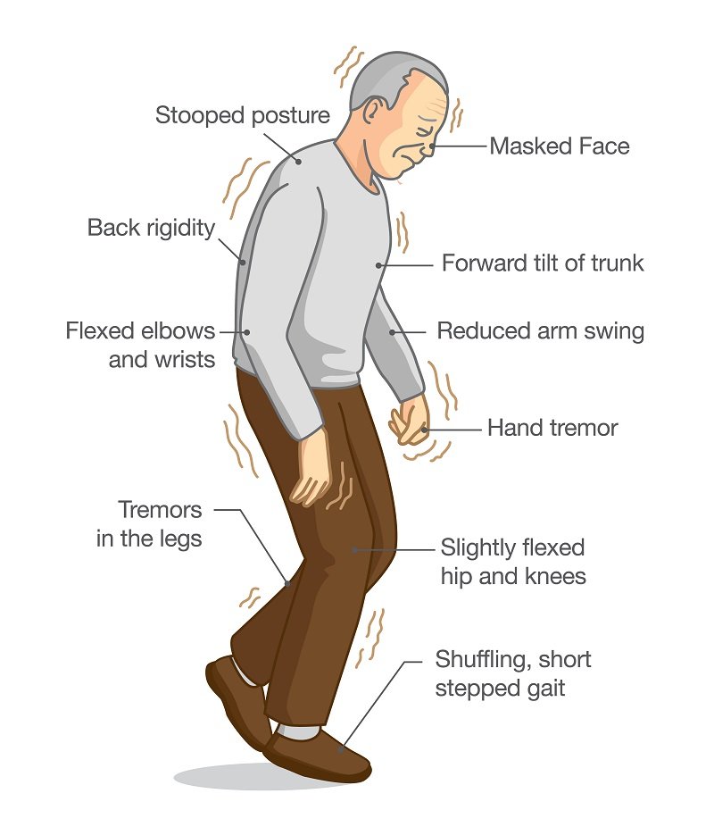 What Are The Signs Parkinson