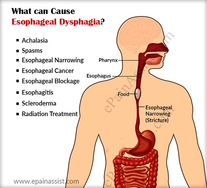 What Causes Dysphagia and How is it Diagnosed and Treated?