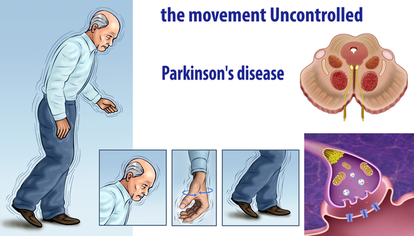 What is the best treatment for Parkinson