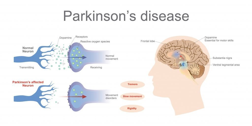 Who Does Parkinson
